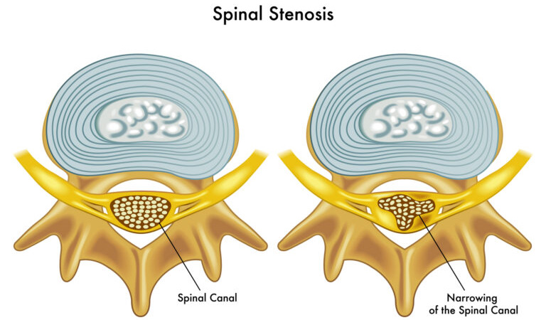 https://www.omgtb.com/wp-content/uploads/2018/02/What-is-Spinal-Stenosis-Post.jpg