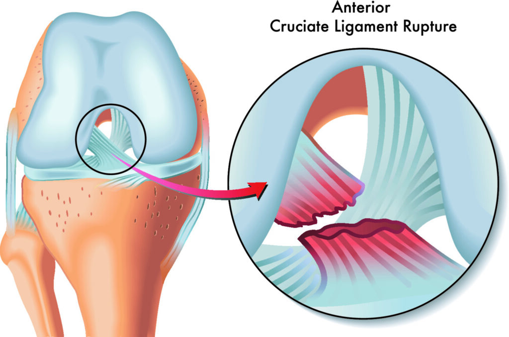 ACL Injury? Here is what you need to know